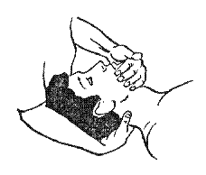 Мобилизация сочленения «затылок-атлас» с выполнением кивательного движения по направлению назад. Исходное положение пациента — на спине, плечи — у головного края кушетки, шея и голова опираются о бедро врача. Врач становится за головой пациента. Захватить голову больного так, чтобы одна рука с помощью разведенных большого и указательного пальцев поддерживала затылок больного на участке задней дуги атласа (позвонок С1), а вторая захватила подбородок пациента